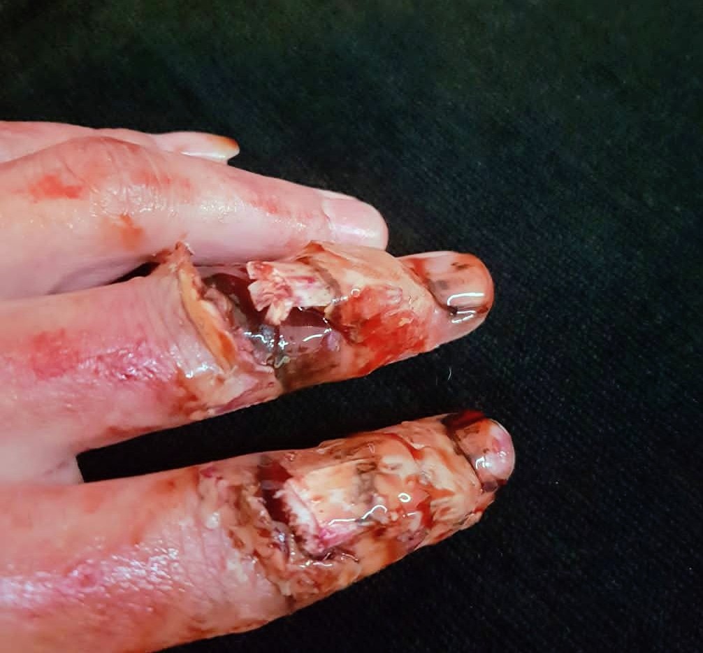 Finger mit geschminkten Verletzungs- und Bluteffekten